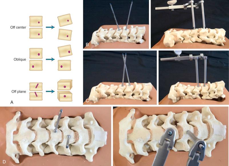 FIG. 105.2, (A) Misplacement of Caspar distraction pins may result in segmental deformity. Placing the pins off center may cause a coronal malalignment. (B) Converging pins will induce kyphosis when distraction is applied. (C) Conversely, diverging pins will induce lordosis. Pins placed obliquely off the midline will create a coronal deformity and a lateral listhesis when distraction is applied. (D) Distracting on pins that are off plane will create a rotational deformity.