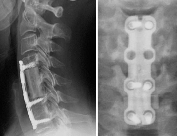 FIG. 105.4, Performing a corpectomy at one level and an adjacent discectomy (corpectomy-discectomy) provides more sites for fixation and allows the maintenance or establishment of lordosis.