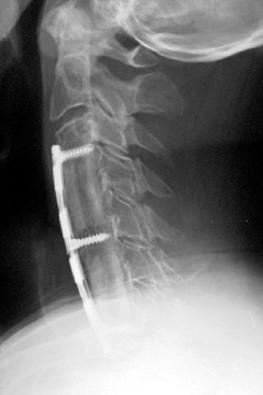 FIG. 105.5, Leaving a vertebral body intact between two corpectomies (corpectomy-corpectomy) provides an additional point of fixation in the middle of a long plate and allows for the maintenance or enhancement of lordosis.