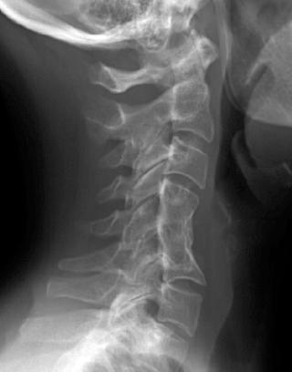 FIG. 105.6, This patient had been treated many years ago with an uninstrumented fusion from C4–C6. The graft appears to have resorbed or collapsed, resulting in segmental kyphosis. Notice the compensatory hyperlordosis at C6–C7.
