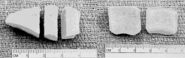 FIG. 105.7, Dense cancellous allograft may be obtained from the patella. This type of graft combines the structural integrity of cortical bone with the healing characteristics of cancellous bone.