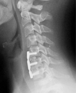 FIG. 105.8, This surgeon placed prefabricated grafts that are clearly undersized, resulting in segmental kyphosis.