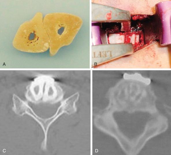 FIG. 105.9, When using cortical allografts, we prefer to use two or three grafts to maximally fill the disc space. (A) Double grafts before insertion. (B) Grafts in place. (C) Radiographic appearance of grafts. (D) At C6–C7 and below, three fibular grafts are occasionally necessary to fill the entire disc space.