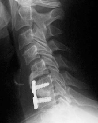 FIG. 105.10, If a plate is too close to the neighboring disc space, adjacent-level ossification disease may occur.