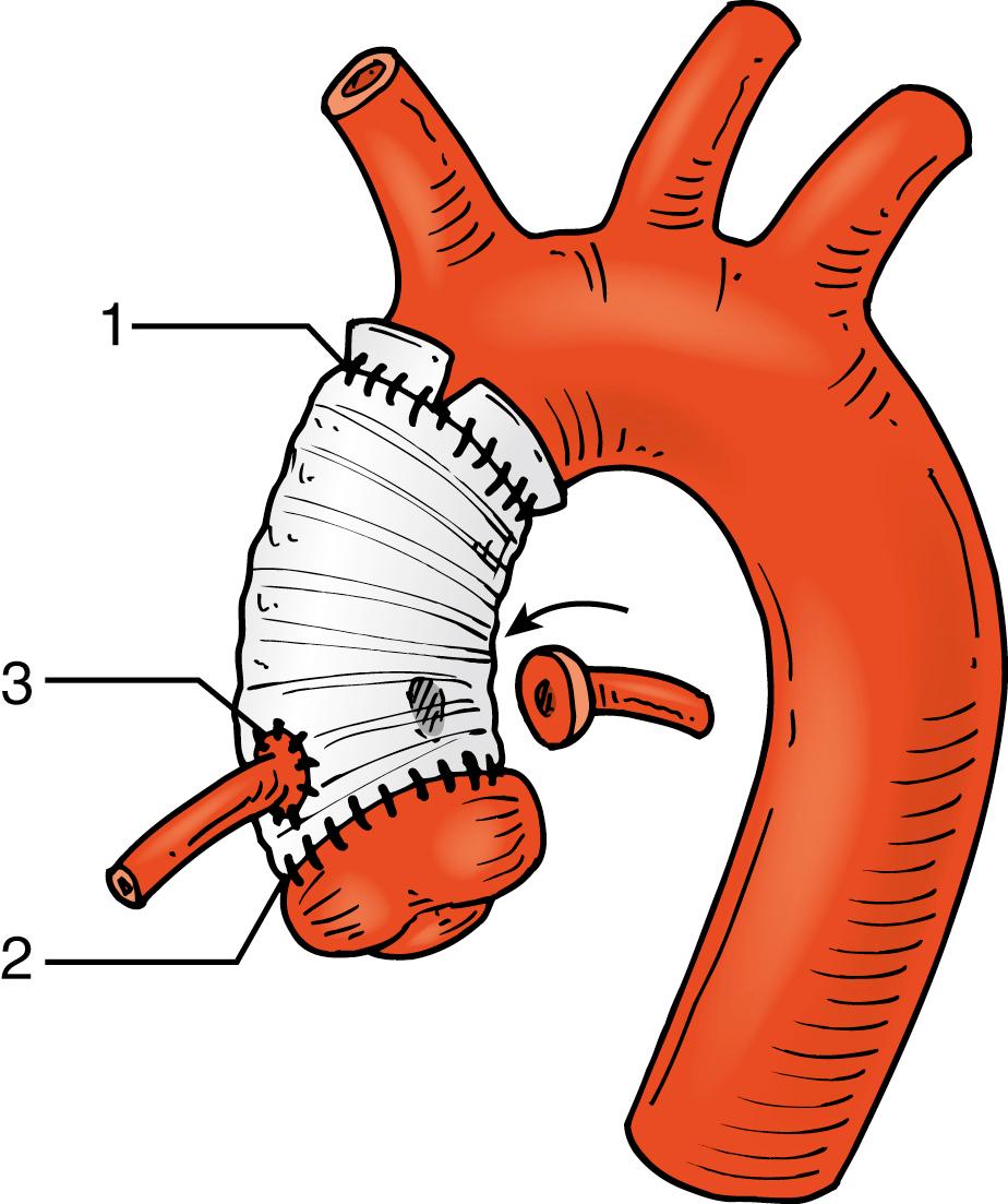 Figure 137.1, The Bentall procedure. The dilated portion of the ascending aorta has been resected and replaced with a Dacron graft. A coronary “button” (curved arrow) was removed from the resected native aorta and is ready to be sutured to the graft. The numbers 1, 2, and 3 represent potential sites of pseudoaneurysm formation: 1 and 2 indicate the proximal and distal anastomotic sites of the graft, and 3 indicates the anastomotic site of the reimplanted coronary artery.