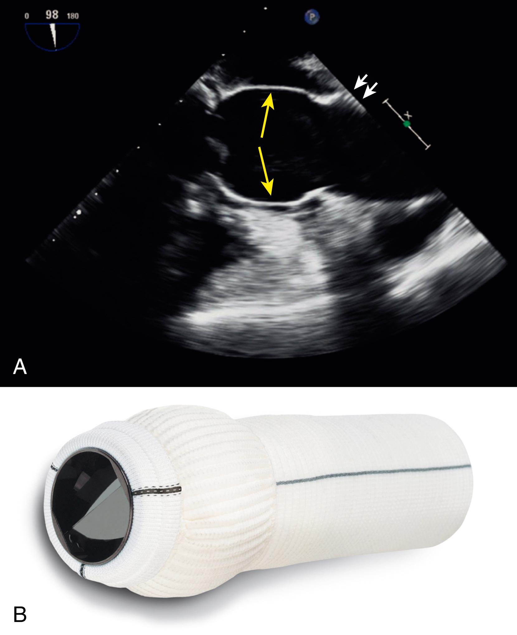 Figure 137.2, A, Transesophageal echocardiogram (longitudinal view of the aorta) illustrates a Valsalva graft. The large yellow arrows indicate the portion of the graft that recreates the sinuses of Valsalva. The small white arrows indicate the “corrugated” appearance of grafts seen on echo. B, An actual composite Vascutek Gelweave Valsalva graft with a mechanical bileaflet tilting disc prosthetic valve.