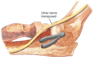 eFIGURE 108-1, Figure-of-eight repair, known as the Tommy John procedure, was the first ulnar collateral ligament reconstruction method. The ligament was exposed by detaching and elevating the flexor-pronator muscle mass from the medial epicondyle of the humerus. A submuscular ulnar nerve transposition was performed. The anterior bundle of the ligament was reconstructed with a harvested autograft (palmaris longus) in a figure-of-eight fashion through two drill holes in the ulna and three in the medial epicondyle.