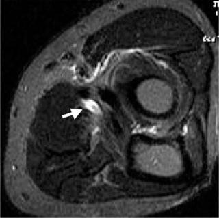 FIGURE 108-6, Axial, fat-suppressed, T2-weighted MR image shows the ulnar nerve transposed anteriorly underneath the pronator muscle (arrow).