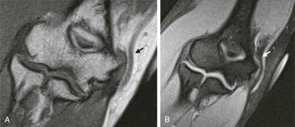 FIGURE 108-7, Coronal, T1-weighted ( A ) and gradient-echo ( B ) MR images of the elbow after ulnar nerve transposition. The nerve lies superficially in the subcutaneous fat (arrows).