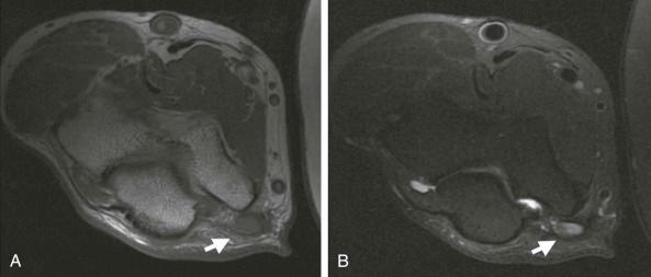 FIGURE 108-8, Ulnar nerve decompression with retinacular release. Axial T1-weighted ( A ) and fat-suppressed, T2-weighted ( B ) MR images of the elbow show the enlarged ulnar nerve subluxed out of the cubital tunnel (arrow) that has undergone a retinacular release. The nerve is abnormally high in signal intensity on the T2-weighted image.