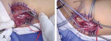 eFIGURE 108-2, A 22-year-old minor league pitcher with ulnar collateral ligament insufficiency who underwent reconstruction using an ipsilateral palmaris longus autograft with the docking technique. A , Double-stranded graft is seen passing through bone tunnels in the humerus with a 1-cm bone bridge between the strands. B , Graft was fixed through the ulna bone tunnel and appropriately tensioned over the bone bridge. Elbow stability returned, and, after rehabilitation, the patient returned to play.