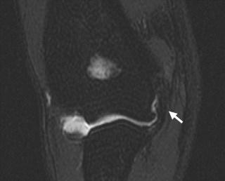 FIGURE 108-1, This coronal T1-weighted MR arthrographic image of a pitcher's elbow demonstrates an intact ulnar collateral ligament 5 years after surgical reconstruction (arrow).