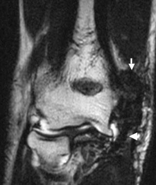 FIGURE 108-2, Intact ulnar collateral ligament repair on a coronal T2-weighted MR image. The normally thickened tendon graft (arrowhead) as well as the scarring above the graft (arrow) can be seen .