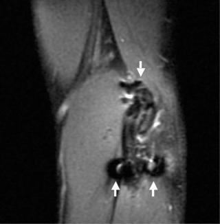 FIGURE 108-3, Sagittal T2-weighted MR image of the elbow demonstrates artifact from screws at both ends (arrows) of an ulnar collateral ligament reconstruction. The ligament was intact.