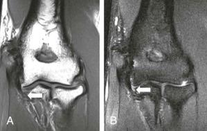 eFIGURE 108-3, Pitfall in imaging diagnosis in the postoperative UCL. T1-weighted coronal ( A ), and proton density–weighted coronal image ( B ), through the elbow demonstrate postoperative changes consistent with UCL reconstruction. The reservoir between the distal UCL attachment and the sublime tubercle (arrow) is a normally encountered variation in the postoperative elbow and should not be mistaken for the T-sign, indicating partial ligament tearing. UCL, Ulnar collateral ligament.