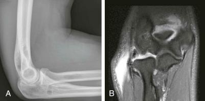 eFIGURE 108-4, A semitendinosus tendon was used as a graft for a tear of the lateral ulnar collateral ligament. A , The lateral elbow radiograph demonstrates tunneling for graft anchor in the supinator crest of the ulna. B , A coronal fat-suppressed, T2-weighted MRI shows the intact neoligament. There was leakage of fluid out of the joint into the neighboring soft tissues through a capsular defect.