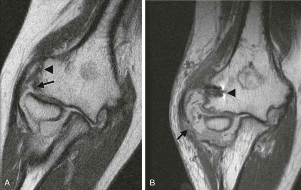 FIGURE 108-4, Lateral ulnar collateral ligament tear with repair. A , There is a high-grade partial tear of the origin of the lateral ulnar collateral ligament at the lateral epicondyle (arrow) on this coronal proton density–weighted MR image of the elbow. The torn common extensor tendon (arrowhead) is shown. B , The lateral ulnar collateral ligament tore again after repair, this time in the mid-distal aspect (arrow). Shown are the metallic hardware (arrowhead) and the joint debris.