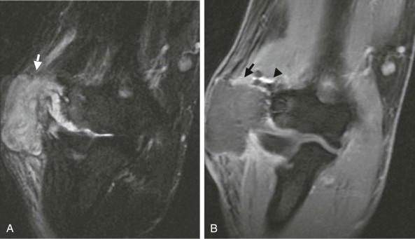 FIGURE 108-5, A , Coronal, fat-suppressed, T2-weighted MR image of the elbow demonstrates a high signal intensity abscess (arrow) communicating with the elbow joint after surgery on the lateral ulnar collateral ligament. B , The abscess rim enhances on the fat-suppressed, coronal, T1-weighted MR image after intravenous administration of gadolinium (arrow). The postoperative metallic artifact (arrowhead) is shown.