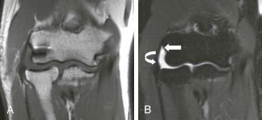 eFIGURE 108-5, Failed LCL repair. T1-weighted ( A ) and coronal T1-weighted, fat-suppressed ( B ) post-arthrogram images through the postoperative elbow show chronic re-tear of the lateral collateral ligament. There is a bare proximal attachment on the humerus (arrow) and distal retraction of the torn ligament with demonstrable caliber change noted (curved arrow). Incidental note is made of postoperative metallic susceptibility artifact best seen on the T1-weighted image. LCL, Lateral collateral ligament.