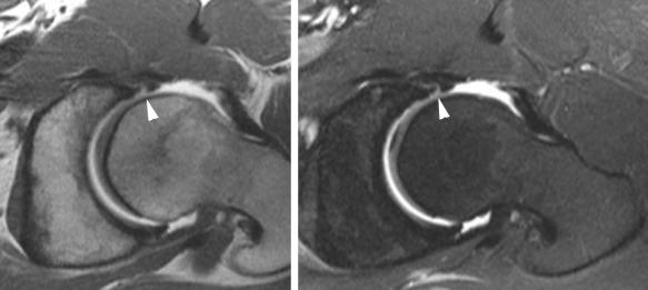 eFIGURE 109-1, Oblique axial image from an MR arthrogram in a 30-year-old professional football player shows postoperative granulation tissue seen on T1-weighted (left) and T2-weighted (right) images within the labral substance (white arrowheads) 2 months after intrasubstance banding.