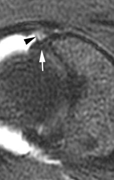 eFIGURE 109-3, Oblique axial, T2-weighted image from a postoperative MR arthrogram shows arthroscopically proven adhesions (black arrowhead) between the capsule and previously repaired anterosuperior labrum (white arrow).