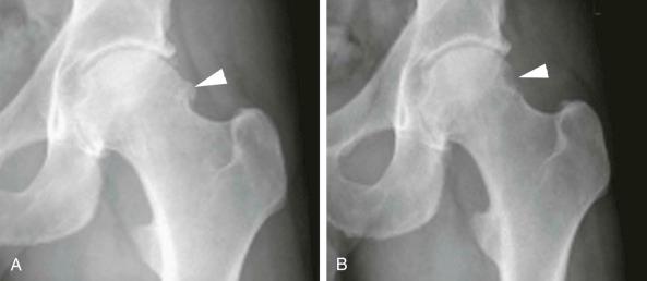 FIGURE 109-1, A , Anteroposterior radiograph of a patient with degenerative change and femoroacetabular impingement (white arrowhead) of the hip who underwent arthroscopic osteochondroplasty. B , Postoperative appearance demonstrated removal of impinging bony excrescence (white arrowhead).
