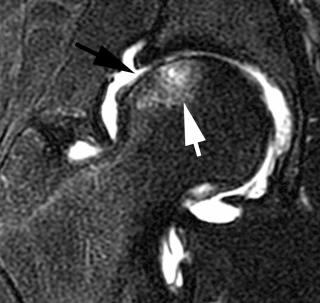 eFIGURE 109-4, Coronal T2-weighted, fat-saturated image from an MR arthrogram shows advanced chondrosis of the femoral head (black arrow) with postoperative marrow edema in the femoral head (white arrow) from microfracture technique.