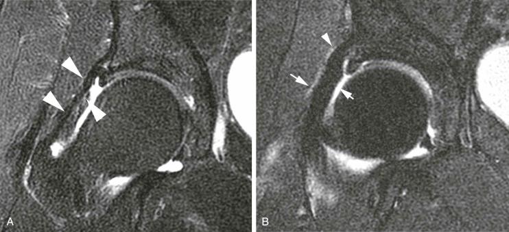 eFIGURE 109-5, A , Coronal T2-weighted, fat-saturated image from MR arthrogram shows markedly attenuated iliofemoral ligament (white arrows) and capsule that was treated with thermal capsulorrhaphy. B , There is postoperative hypertrophic change and enlarged morphology of the ligament (white arrows) as compared with the preoperative state 6 months earlier.