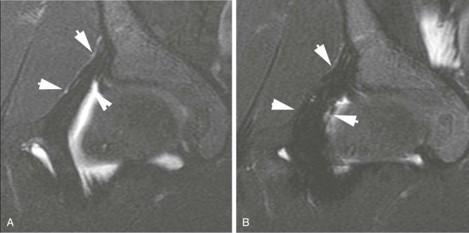 eFIGURE 109-6, A , Coronal T2-weighted, fat-saturated MR image shows attenuated iliofemoral ligament (white arrows) that was treated with suture plication. B , Postoperative image shows minimal artifact from suture material with enlarged appearance of the iliofemoral ligament (white arrows), implying improved structural integrity.