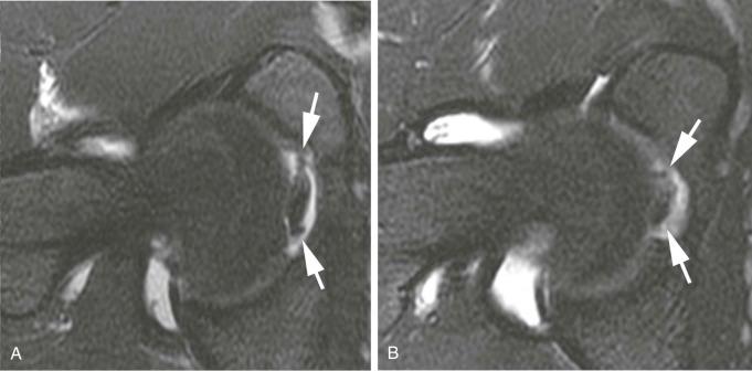 eFIGURE 109-7, A , Oblique axial, T2-weighted, fat-saturated MR image from MR arthrogram with hypertrophic and irregular appearance of partial torn ligamentum teres (white arrows) that was confirmed arthroscopically and débrided. B , Postoperative image 6 months later in same patient demonstrates smooth, well-marginated appearance of the ligamentum teres (white arrows).