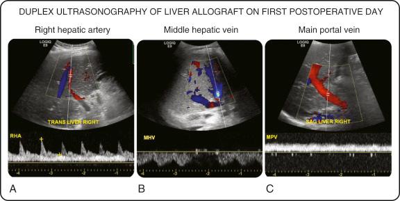 FIGURE 69-2, Duplex ultrasonography (DUS) allows measurement of the graft inflow and outflow hemodynamics. A, Hepatic artery assessment (inflow) using the resistive index (RI). The RI should be between 0.6 and 0.9. B, Hepatic vein assessment (outflow) for triphasic flow, which should be in the opposite direction of the hepatic artery. C, Portal vein assessment (inflow) for flow, looking for velocity changes indicative of a stenosis.