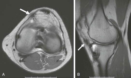 eFIGURE 110-1, Arthroscopy scars. Axial ( A ) and sagittal ( B ) intermediate echo-time MR images show the typical scars (arrows) from arthroscopic portal placement. There are usually medial and lateral scars.