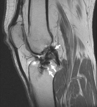 FIGURE 110-5, Hamstring reconstruction augmentation. Sagittal, intermediate echo-time MR image shows ACL reconstruction. Multiple low signal foci with dephasing artifact are related to graft augmentation, often done with suture (arrows). ACL, Anterior cruciate ligament.