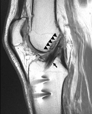 FIGURE 110-6, Normal ACL reconstruction. Sagittal, fast spin-echo, intermediate echo-time MR image shows a low signal graft parallel to Blumensaat line (arrowheads). The tibial tunnel (black arrow) enters the tibia at the posterior portion of the native ligament, and the femoral attachment is posterior, at the posterior cortex of the distal femur. ACL, Anterior cruciate ligament.