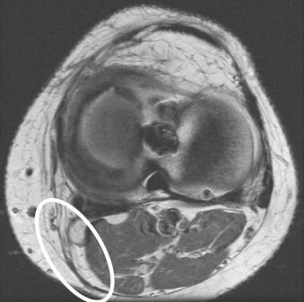 eFIGURE 110-7, Hamstring harvest. Axial, intermediate echo-time MR image at the level of the femorotibial joint demonstrates poor definition of the hamstring tendons, indicating that they have been harvested for the patient's ACL reconstruction. ACL, Anterior cruciate ligament.