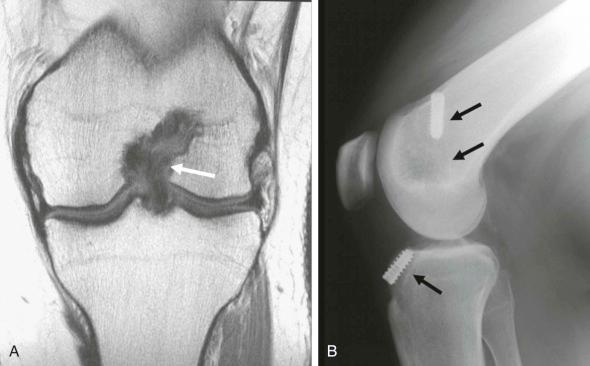 FIGURE 110-7, Graft impingement. A , Coronal MR image of the knee shows that the ACL graft is displaced by the lateral femoral condyle in the intercondylar notch (white arrow). This is related to poor placement of the graft. B , Lateral radiograph shows, by the position of the interference screws, that the femoral tunnel is too far anterior and the tibial tunnel is too anterior and shallow (black arrows). ACL, Anterior cruciate ligament.