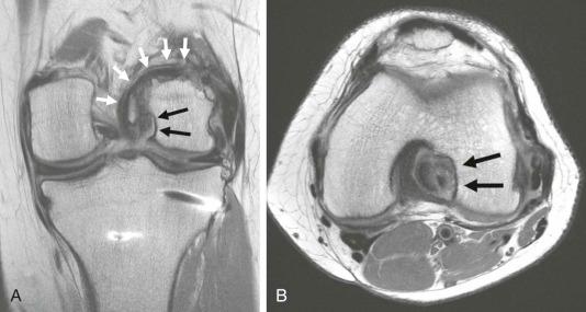 eFIGURE 110-8, Over-the-top ACL reconstruction. Notchplasty. A , Coronal intermediate echo-time MR image shows an ACL reconstruction (white arrows) that courses over the lateral femoral condyle, rather than going through an osseous femoral tunnel. B , Both the coronal and the axial ( B ) MR image show notchplasty (black arrows) in which bone is removed from the condyle to prevent graft impingement. ACL, Anterior cruciate ligament.