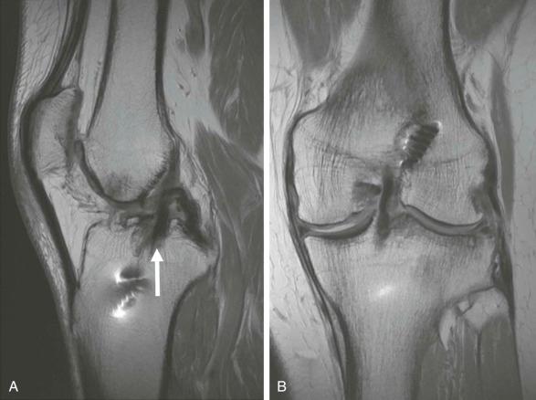 eFIGURE 110-9, Poor ACL graft placement. Proper graft placement is important to the proper function of the graft. Sagittal ( A ) and coronal ( B ) intermediate echo-time MR images show posterior placement of the ACL graft ( A , arrow ), causing a relative vertical orientation in the sagittal plane. The graft is also vertical in the coronal plane. There is mild arthrosis with chondral loss in all compartments and a small subchondral cyst in the lateral tibial plateau. Changes of partial medial meniscectomy and slight increased signal intensity in the lateral meniscus are also noted. ACL, Anterior cruciate ligament.