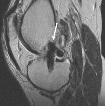 eFIGURE 110-10, Poor ACL graft placement. Oblique sagittal T2-weighted MR sequence shows anterior placement on the femoral side (arrow), causing vertical orientation of the graft. This contributes to rotational instability. ACL, Anterior cruciate ligament.