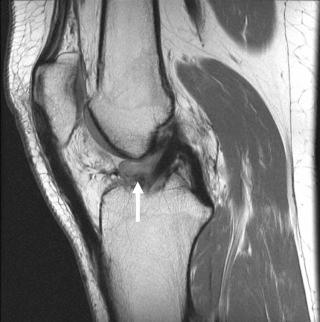 FIGURE 110-8, Cyclops lesion. Sagittal, midline, intermediate echo-time MR image shows intermediate signal scar in the intercondylar notch anterior to the ACL, called a Cyclops lesion (arrow). ACL, Anterior cruciate ligament.