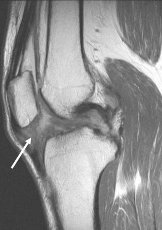 FIGURE 110-9, Arthrofibrosis. Some patients have an inflammatory reaction that results in dense scar of the joint and limited motion. This sagittal MR image shows complete filling of the infrapatellar fat with abnormal low signal (arrow) —the hallmark of arthrofibrosis.