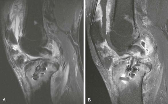 eFIGURE 110-11, Infected ACL reconstruction. Sagittal short tau inversion recovery ( A ) and fat-suppressed, contrast-enhanced, T1-weighted ( B ) MR images show high signal with enhancement in the tibia, around the graft, in the joint, and in the surrounding soft tissues anterior and posterior to the tibia, indicating graft infection with associated septic arthritis. ACL, Anterior cruciate ligament.