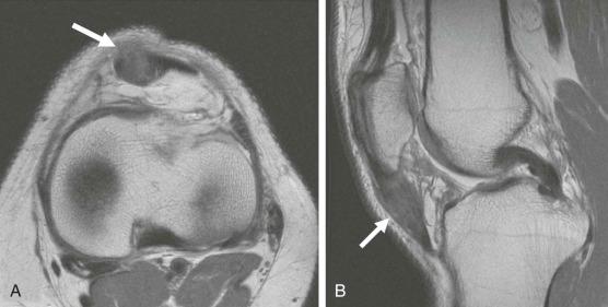 eFIGURE 110-2, Patellar tendon scar. Axial ( A ) and sagittal ( B ) MR images show patellar tendon abnormality (arrows) from an arthroscopic portal being placed through it.