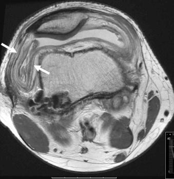 eFIGURE 110-12, Infected ACL reconstruction. Same patient as in eFigure 110-11 . On this axial, intermediate echo-time MR image, the layered synovial thickening suggests the presence of infection (arrows). ACL, Anterior cruciate ligament.