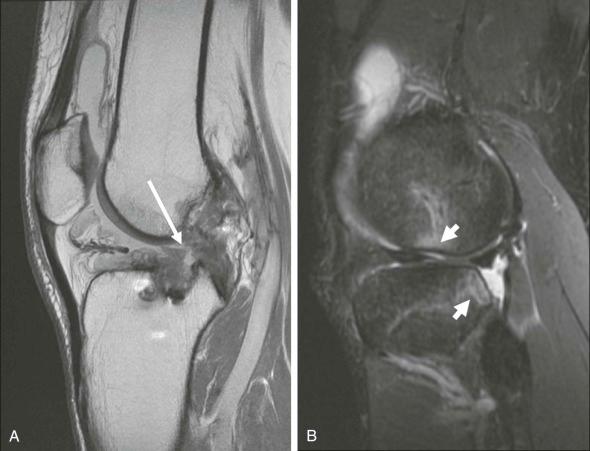 eFIGURE 110-13, Re-tear of ACL reconstruction. A , Sagittal MR image shows a defect (long arrow) in the middle third of this ACL reconstruction, reflecting acute complete tear. Anterior tibial translation is a secondary sign. B , Sagittal fat-suppressed image of a different patient with acute ACL reconstruction re-tear shows the characteristic translational impaction injuries (short arrows). ACL, Anterior cruciate ligament.