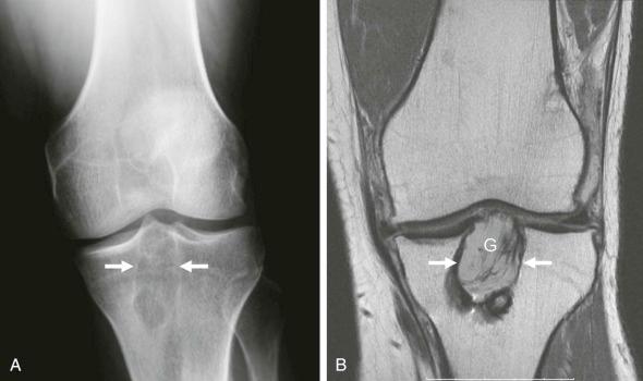 eFIGURE 110-14, Postoperative tibial tunnel widening/ACL ganglion. Frontal radiograph ( A ) and coronal MR image using an intermediate echo-time sequence ( B ) show evidence of ACL reconstruction with widening of the tibial tunnel (between the arrows) related to ganglion (G) within the reconstructed ligament. Normally, the tunnel width is less than 1.5 cm. ACL, Anterior cruciate ligament.