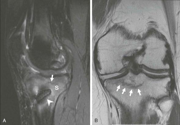 eFIGURE 110-15, Stress fracture. Sagittal short tau inversion recovery ( A ) and coronal intermediate echo-time ( B ) MR images in a patient who has undergone ACL reconstruction and has a stress fracture of the proximal tibia. In A, there is extensive reactive high signal (s) and the hint of the fracture line (arrow). The higher-resolution, fast spin-echo sequence in B shows the medullary fracture (small arrows). The interference screw is visible (arrowhead). The appearance is the same as it would be if there had been no surgery. ACL, Anterior cruciate ligament.