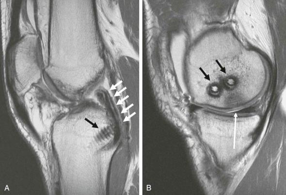 FIGURE 110-10, Posterior cruciate ligament reconstruction. Sagittal midline ( A ) and medial ( B ) MR sections through the knee demonstrate an intact reconstruction (white arrows) (the proximal aspect is not visible on these slices). There is one distal and two proximal interference screws (black arrows) to better approximate the native ligament. Previous chondroplasty was performed ( B , long arrow ), and the overlying reparative cartilage is minimally thin and mildly of high signal.