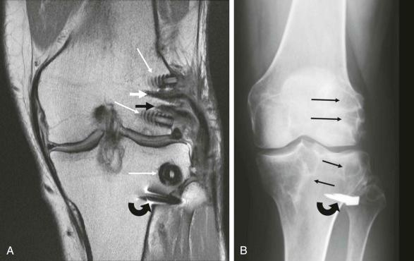 eFIGURE 110-16, Posterolateral corner reconstruction. Coronal image of an intermediate echo-time MR study ( A ) shows bioabsorbable interference screws (long white arrows) fixating the lateral collateral ligament (white arrow) and popliteus tendon (black arrow) reconstructions in a patient with additional ACL reconstruction. Tibial staple fixation is also present and better seen on radiograph ( B ) where the tunnels for the reconstructions are visible (long black arrows) but not the interference screws. ACL, Anterior cruciate ligament.