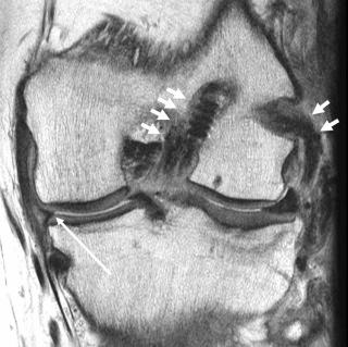 FIGURE 110-11, Posterolateral corner and ACL reconstruction. Coronal, intermediate echo-time MR image shows ACL and fibular collateral ligament reconstructions (short white arrows). After meniscectomy, change is noted in the medial meniscus (long white arrow). ACL, Anterior cruciate ligament.